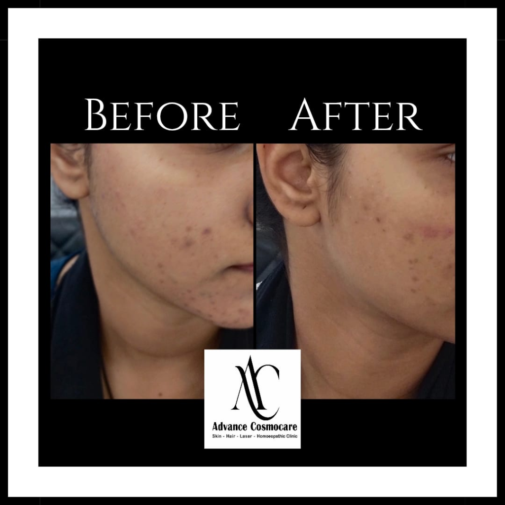 Chemical Peel Before and After Clinical Result showing acne marks clearance and skin brightness improvement