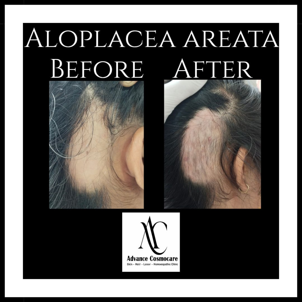 Hair Restoration Before and After Clinical Result showing Alopecia Areata patch recovery