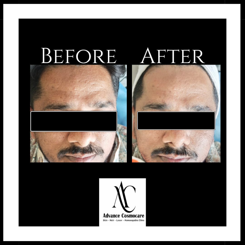 Laser Toning and Carbon Peel Before and After Clinical Result showing skin tone, pores, and pigmentation clearance