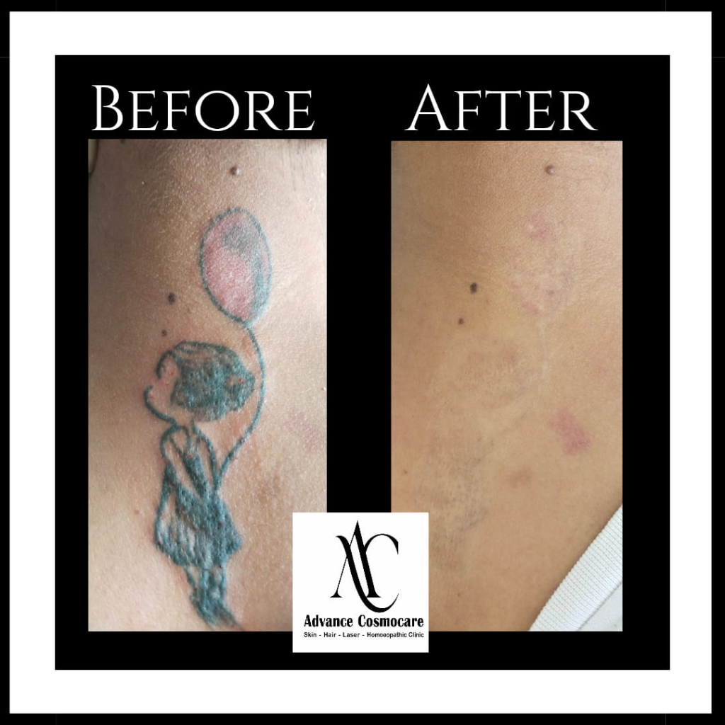 Laser Tattoo Removal Before and After Clinical Result showing gradual fading of black and colored ink